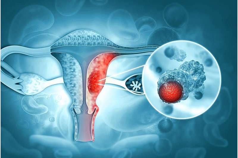 Pembrolizumab aids survival with high-risk endometrial cancer