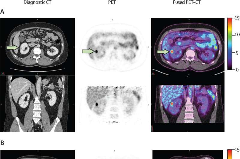 New imaging technique accurately detects aggressive kidney cancer