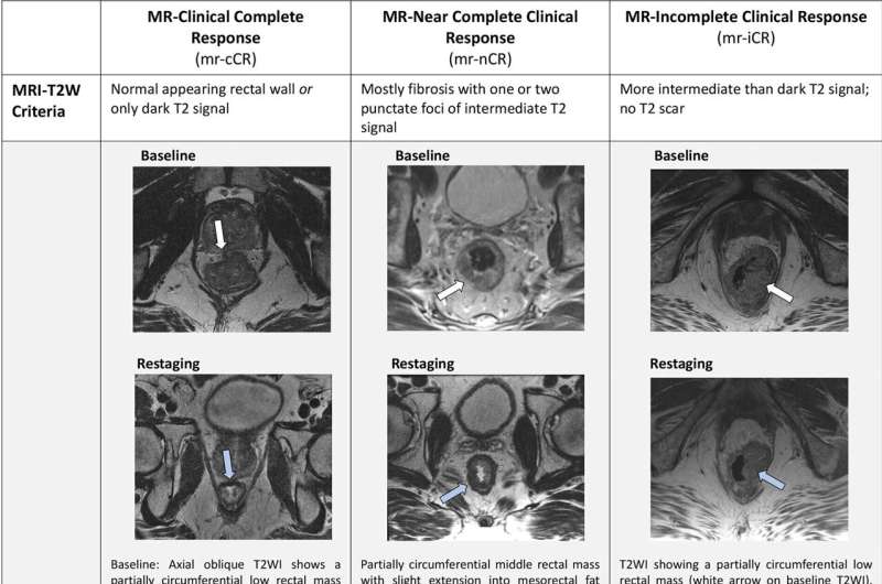 MRI can save rectal cancer patients from surgery, study suggests