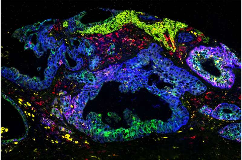 Researchers develop insights into KRAS mutations in pancreatic cancers