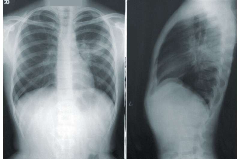 Performance in physical tests can help manage treatment for metastatic lung cancer