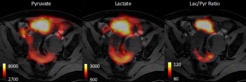 Imaging technique allows rapid assessment of ovarian cancer subtypes and their response to treatment