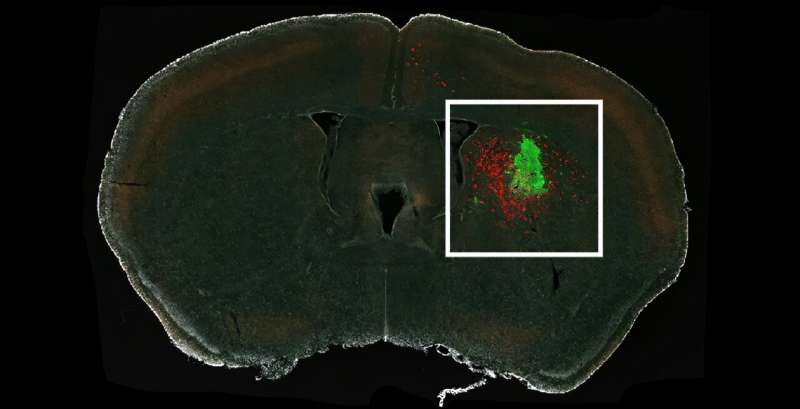 First look at neuron–tumor connections in brain illuminates formation and spread of gliomas