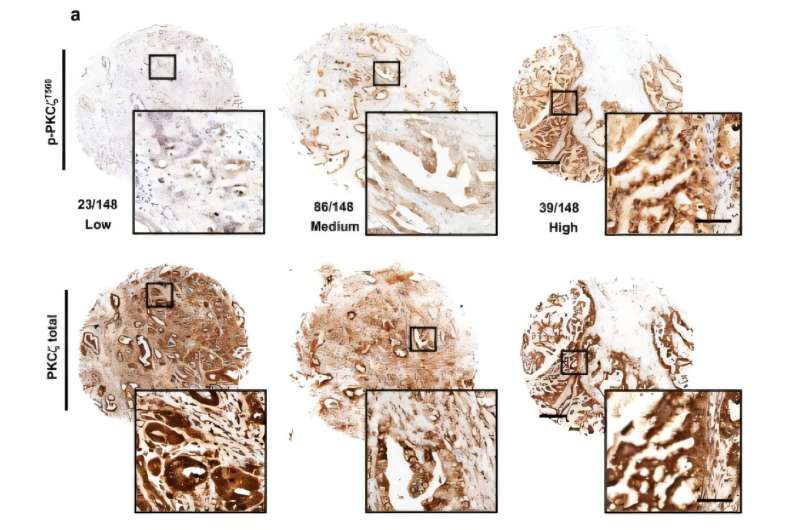 A pair of enzymes provides insights in how pancreatic cancer cells adapt when resources are scarce