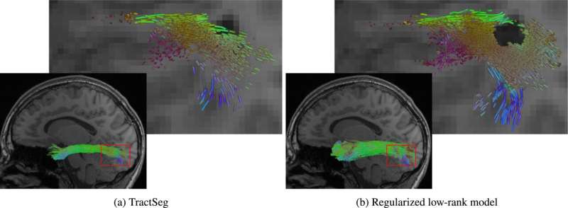 AI enhances brain imaging—optimizing tractography for surgical procedures