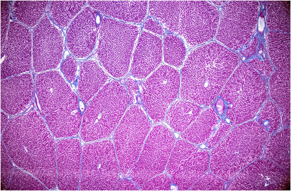 DNA/RNA Sequencing Aids Subsequent Treatment Selection in HCC/H-CCK Post Atezolizumab/Bevacizumab 