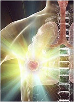 Iruplinalkib Improves PFS Vs Crizotinib in Locally Advanced or Metastatic ALK+ NSCLC 