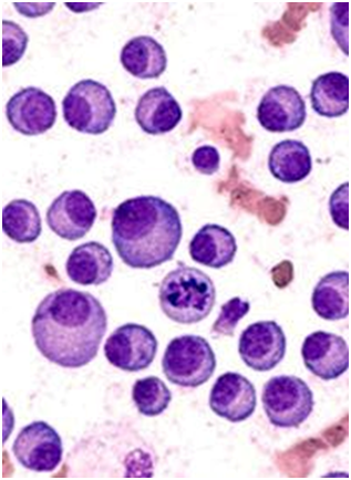 Daratumumab Plus Induction Therapy Reduces Stem Cell Yield in Multiple Myeloma 