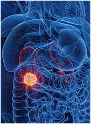 Frontline Immunotherapy, Delayed Nephrectomy May Allow for Improved Disease Control in mRCC 