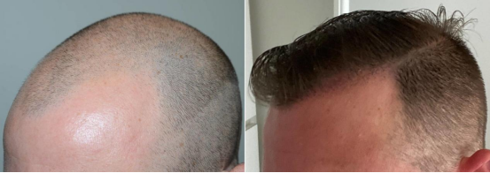 Hair transplantation: standard guidelines of care