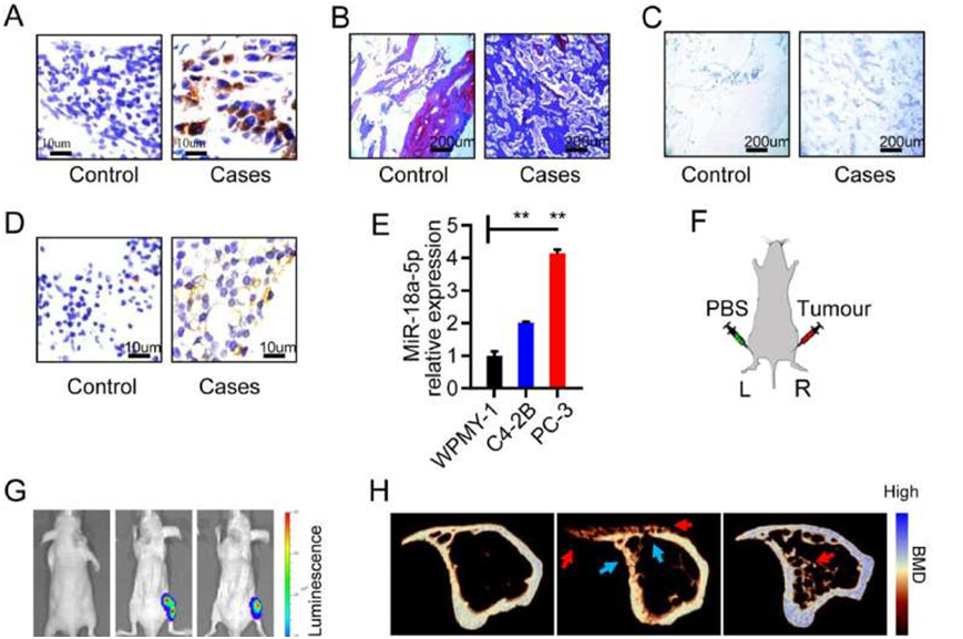 Study reveals promising therapeutic approach for prostate cancer bone metastasis 