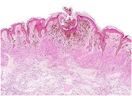 Adjuvant Nivolumab Receives CHMP Recommendation for Completely Resected Stage IIB/C Melanoma 