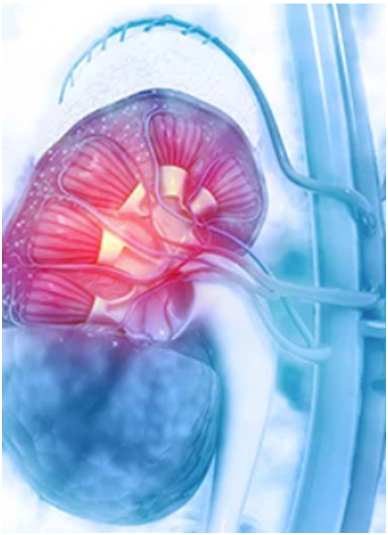 ICI-Treated Synchronous mRCC Is Associated With Negative Survival Outcomes 