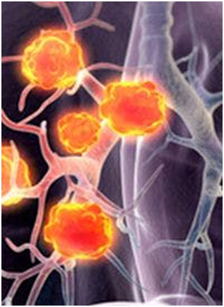 DetermaIO Assay Helps Inform Benefit With Single-Agent Immunotherapy in Advanced NSCLC 