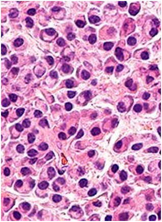 Cilta-cel Provides Durable Responses in Lenalidomide-Refractory Myeloma After 1 to 3 Prior Lines  