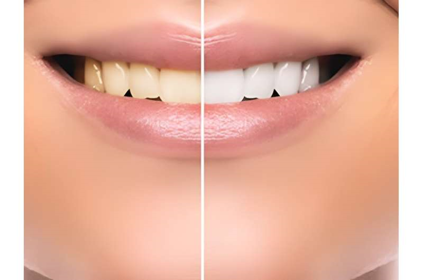 Tooth whitening: Expert help on getting a brighter smile