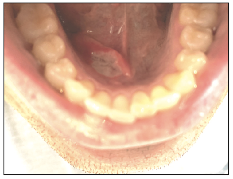 Traumatic Ulcerative Granuloma With Stromal Eosinophilia: A Case Report