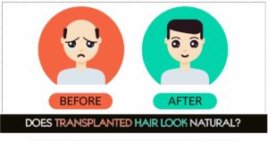 Does-Transplanted-Hair-Look-Natural-300x158