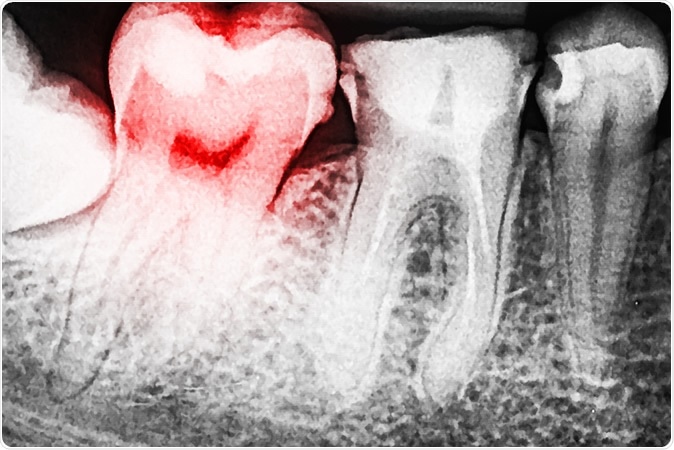 Tooth Decay. Image Credit: Radu Bercan / Shutterstock