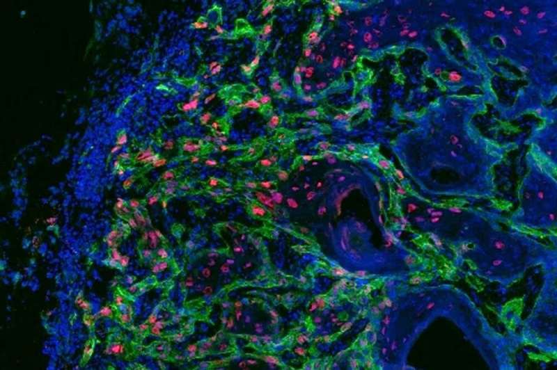 Squamous cell carcinoma study: Cancer stem cells are fueled through dialogue with their 