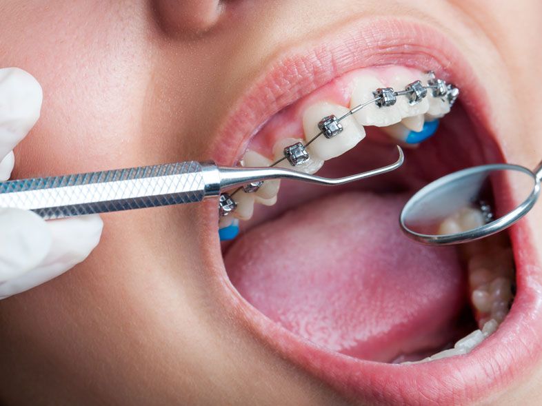 Why Crooked Teeth are bad for your Health