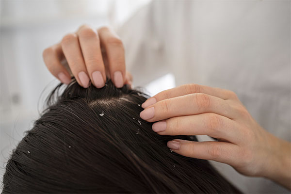 Hair loss related to autoimmunity