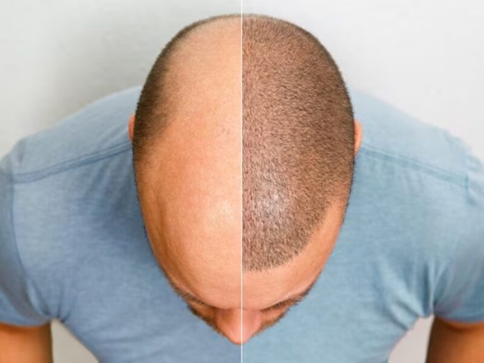 Why is there inflammation after hair transplantation?