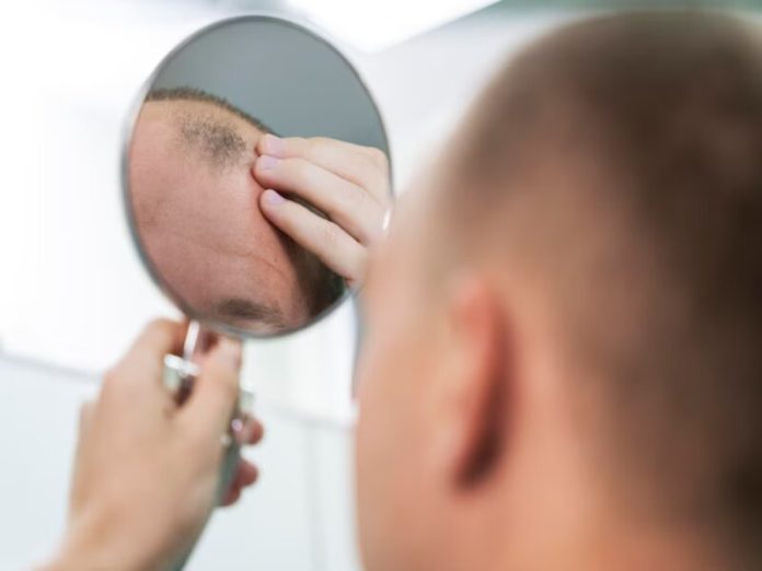 Hair loss, responsible for baldness?