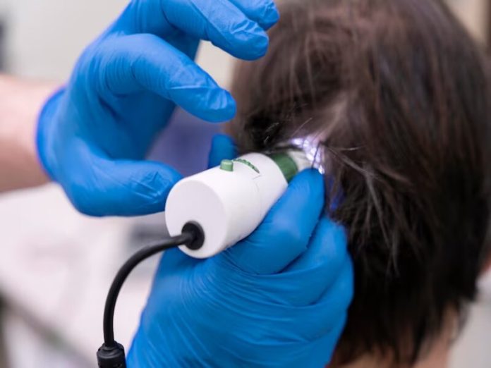 Traitement au laser pour la perte de cheveux