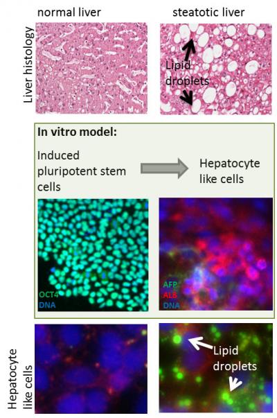 Modeling NAFLD with human pluripotent stem cell derived immature hepatocyte like cells