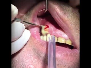 How to drain a gum abscess