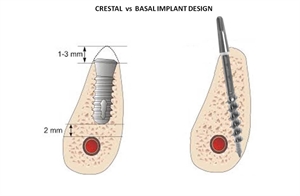 Are bicortical implants better than normal implants for patients who are smokers?