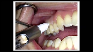 Intraosseous injections