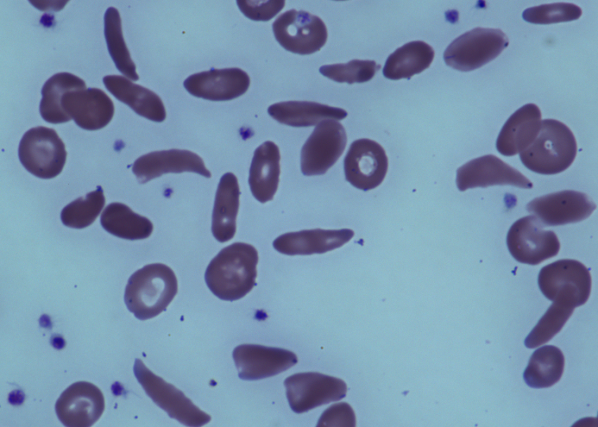 Adults stop anti-rejection drugs after stem-cell transplant reverses sickle cell disease