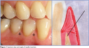 Intraseptal injection in dentistry