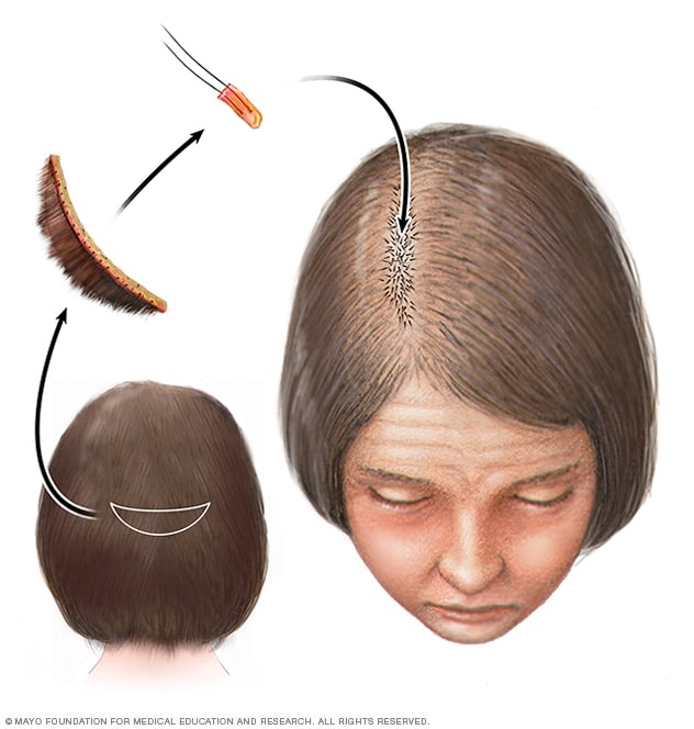 Hair loss