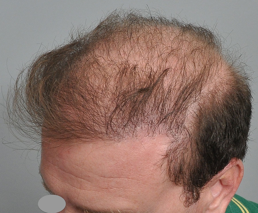 bad-hair-transplant_637553348416020793