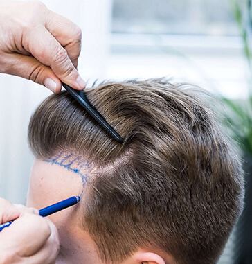 Does Hair Fall Out after a Hair Transplant?