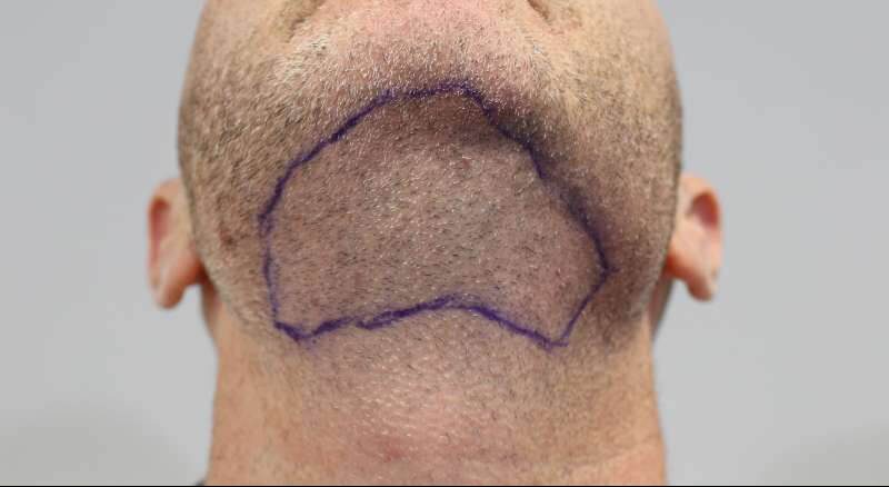 Hair Transplant From Beard to Scalp