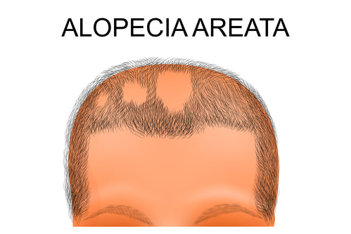 alopecia-areata-ccl-1