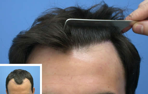 how-to-perform-a-natural-hair-transplant_637553348246686314