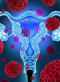 Mirvetuximab Soravtansine Plus 

Bevacizumab in Ovarian Cancer | 

Image Credit: © freshidea - stock.adobe.com