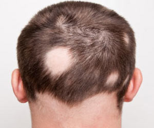 Hair Loss Symptom Evaluation