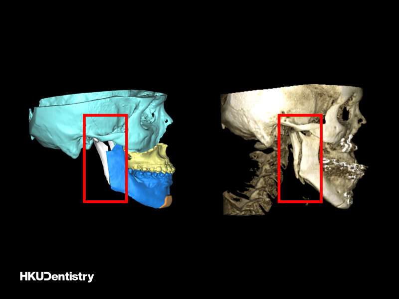 Study shows internal fixation surgery linked with improvement in long jaw patients' quality of life