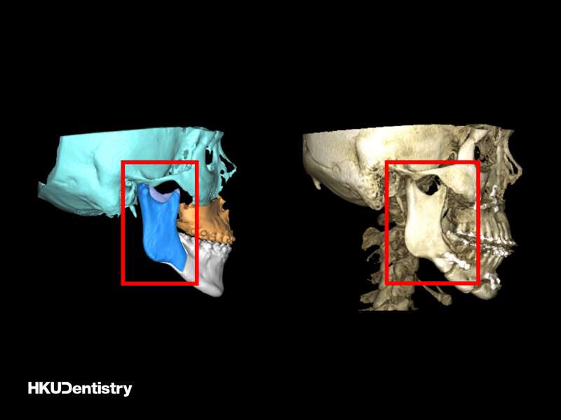 Study shows internal fixation surgery linked with improvement in long jaw patients' quality of life