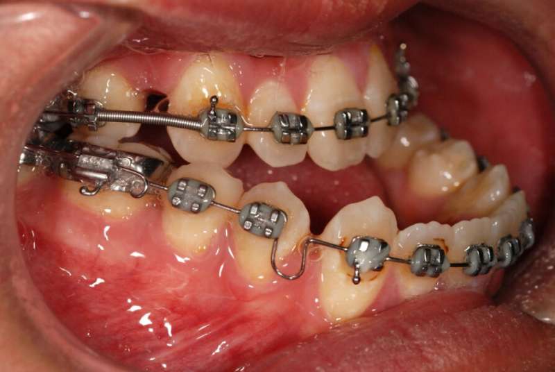 Study shows internal fixation surgery linked with improvement in long jaw patients' quality of life