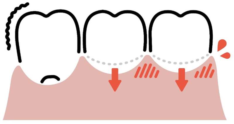 Study reveals that soft gums are more prone to inflammation