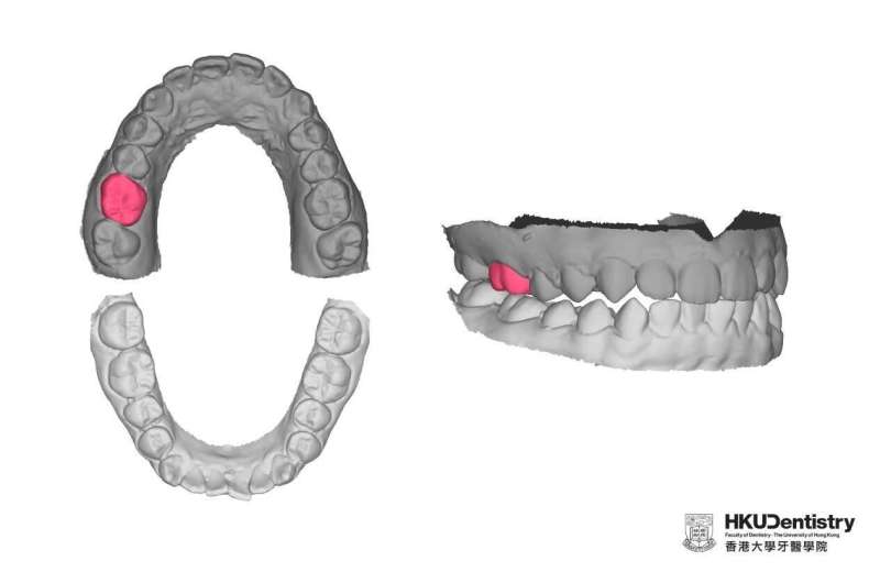 Artificial intelligence-designed single molar dental prostheses