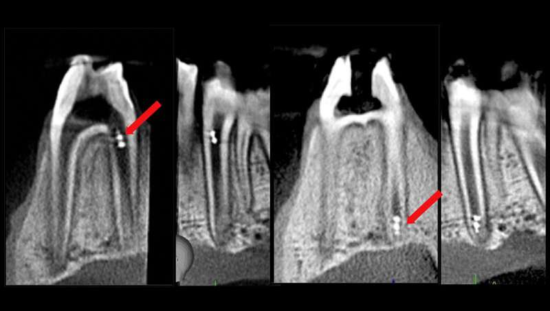 Penn Dental Medicine study applies microrobotics in endodontic treatment, diagnostics