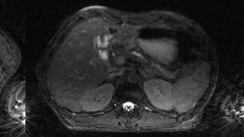 Pancreatic adenocarcinoma 4D-MRI reconstructed using the new high-performance computing method. Credit: Physics and Imaging in Radiation Oncology (2023). DOI: 10.1016/j.phro.2023.100484